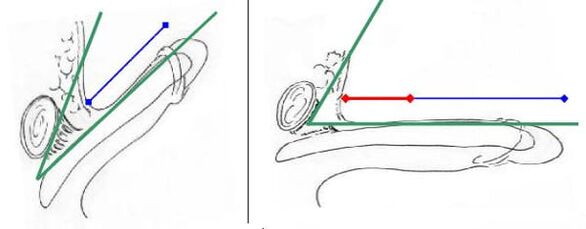 Increased length of the penis due to the intersection of the ligament