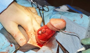 penis enlargement surgery