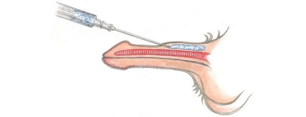 Lipofilling, which allows to increase the size of the phallus